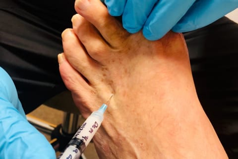 An injection given into the top of the foot between two toe bones