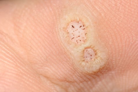 Two plantar warts on the sole, ringed by thick skin, with tiny black dots in the center