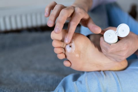 Applying a wart treatment to a plantar wart on the ball of the foot