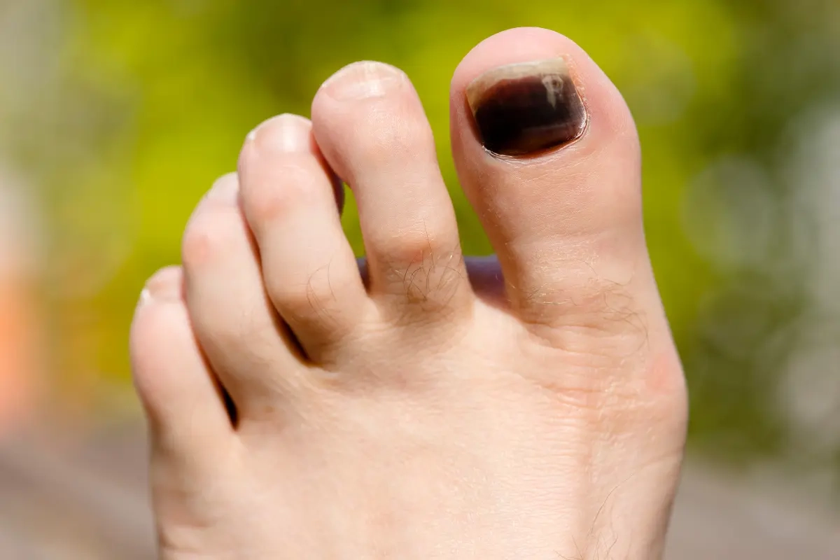Foot with black spot on toenail