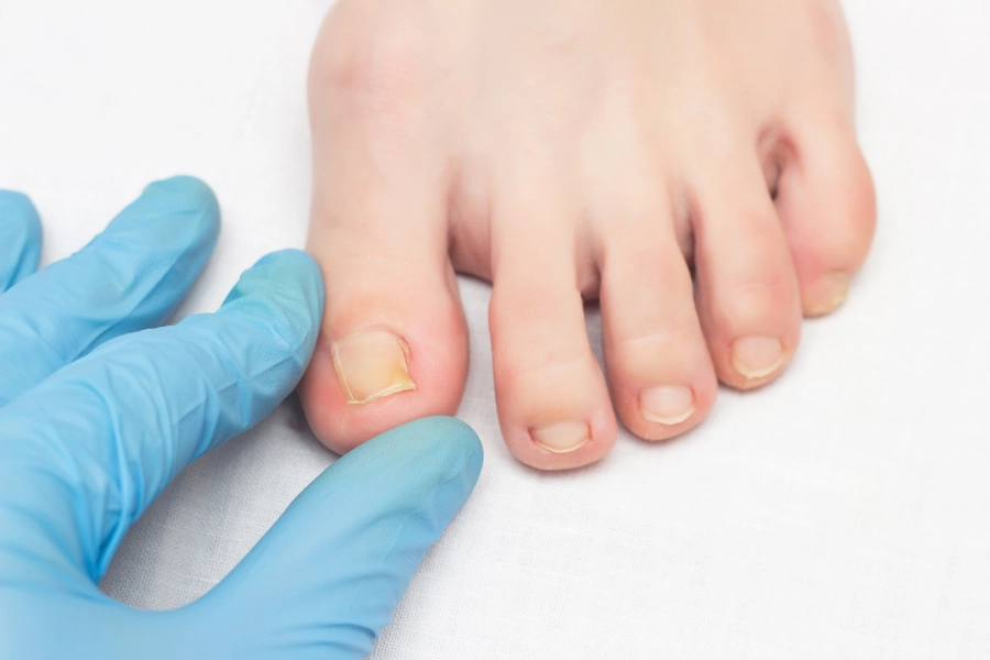 Toenail fungus doctor examining a patient’s foot with mild nail fungus using blue medical glov.