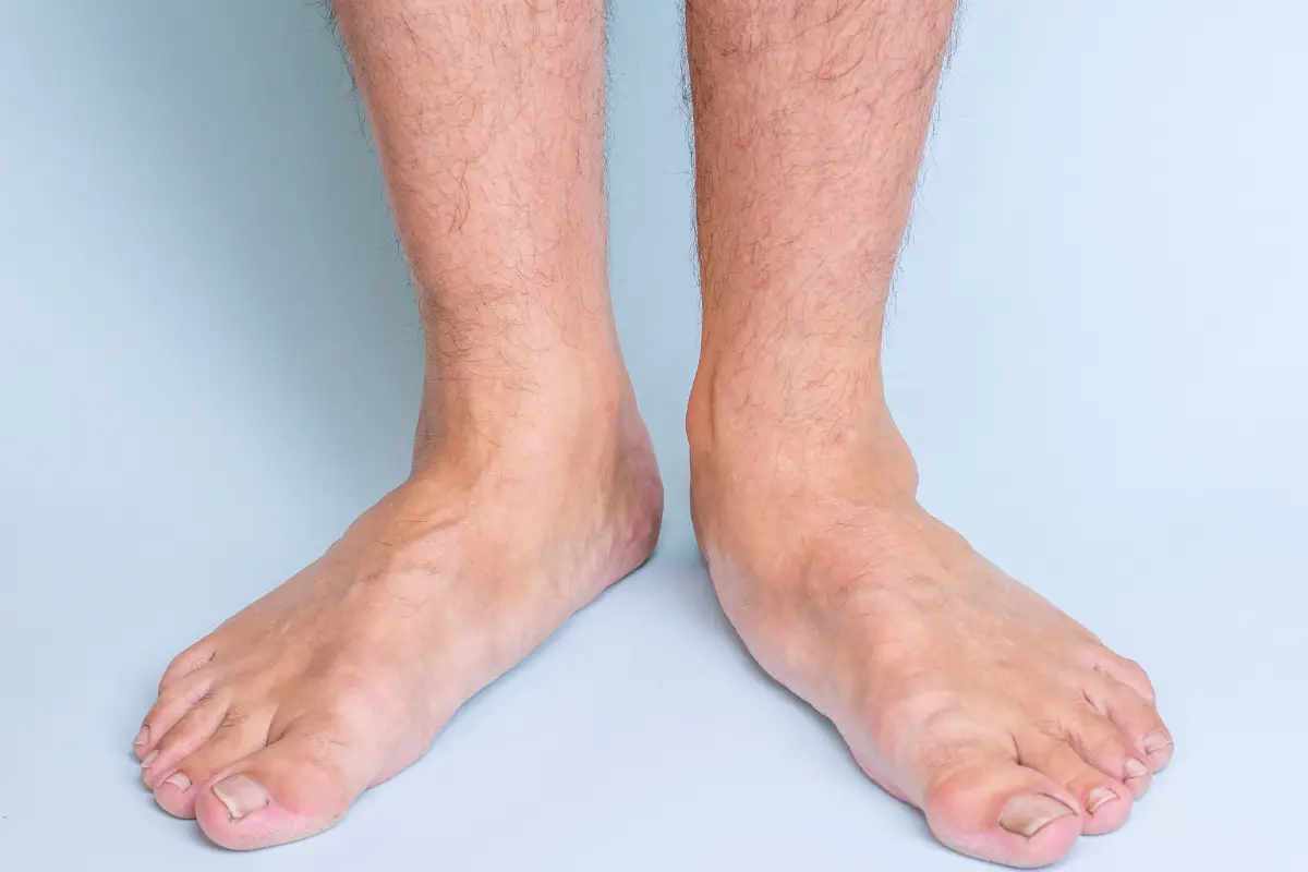 Adult feet with flat arches showing signs of flat feet (pes planus)