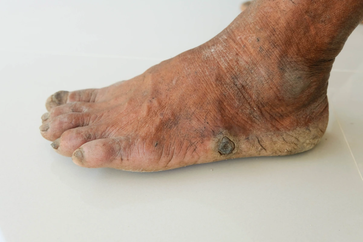 Diabetic foot with ulcer requiring podiatrist evaluation and specialized diabetic shoes at Evolve Health.