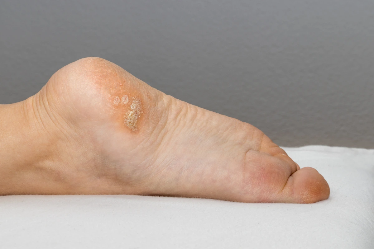 Plantar warts treatment shown on the heel of a foot to illustrate common symptoms