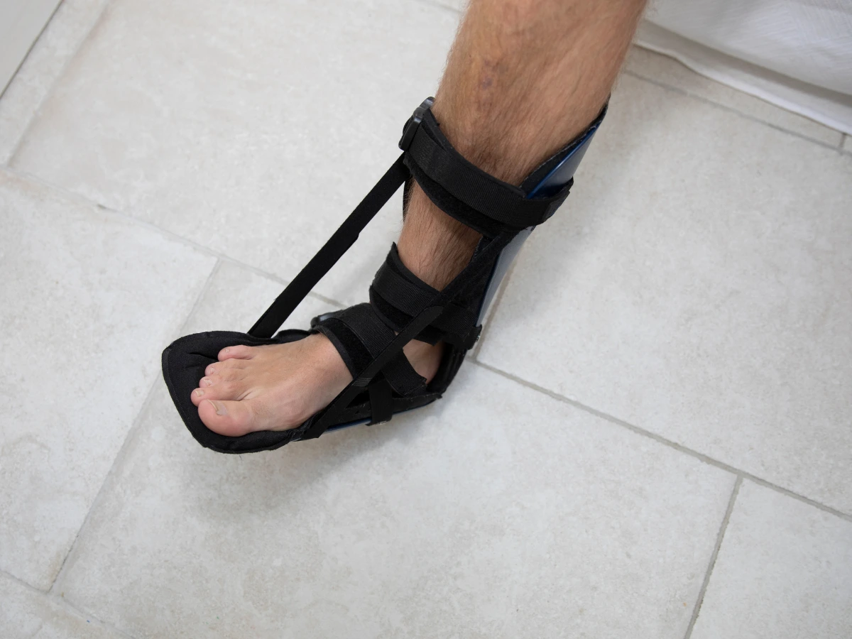 Plantar fasciitis night splint holding the foot in a dorsiflexed position